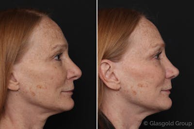 Revision Rhinoplasty Before & After Gallery - Patient 113374 - Image 1