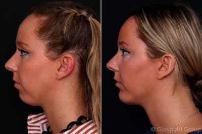 Chin Implants Before & After Gallery - Patient 530562 - Image 1