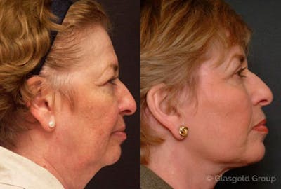 Lower Eyelid Before & After Gallery - Patient 205876 - Image 1
