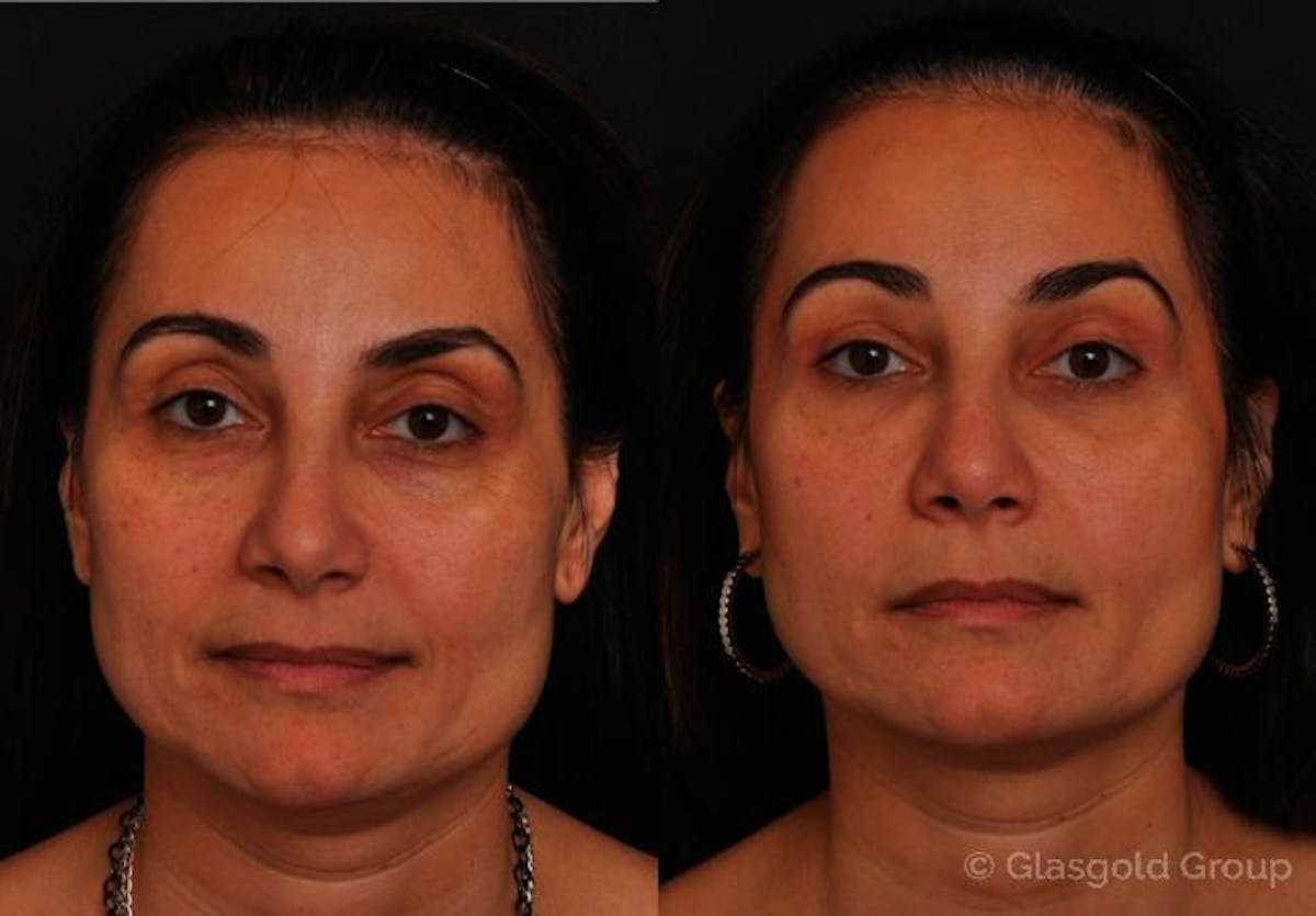 Upper Eyelid Before & After Gallery - Patient 751529 - Image 2