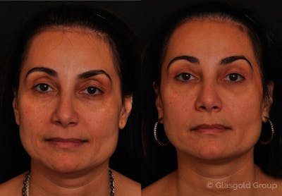 Upper Eyelid Before & After Gallery - Patient 751529 - Image 1