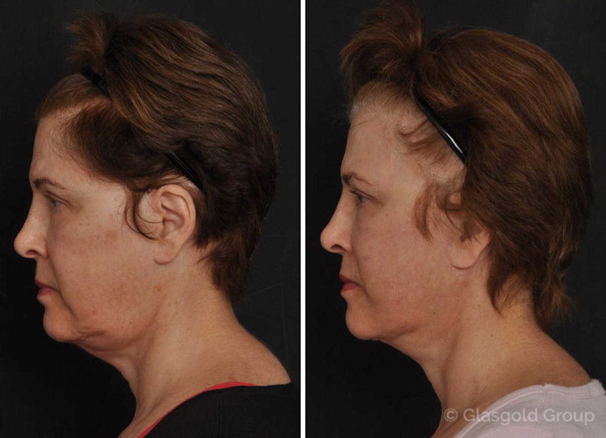 Revision Facelift Before & After Gallery - Patient 236254 - Image 1