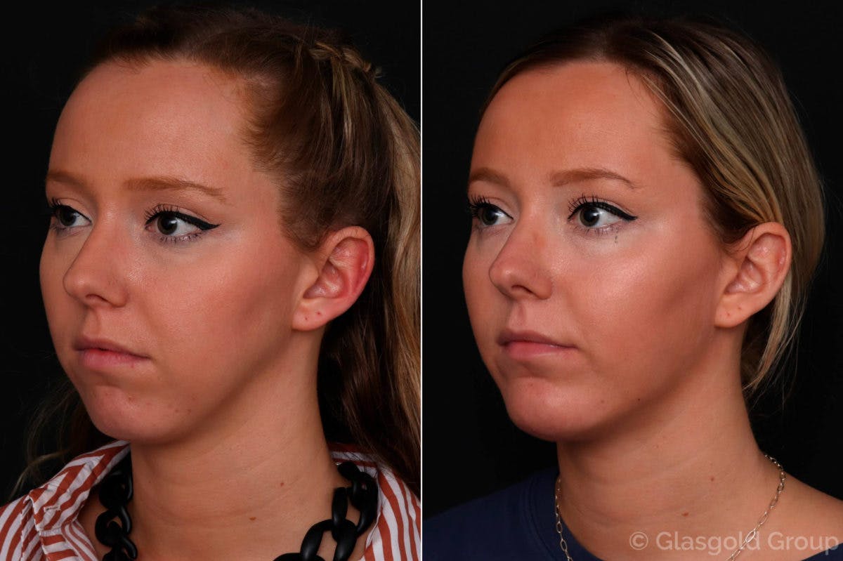 Chin Implants Before & After Gallery - Patient 530562 - Image 3