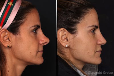 Revision Rhinoplasty Before & After Gallery - Patient 189805 - Image 1