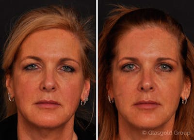 Upper Eyelid Before & After Gallery - Patient 403813 - Image 1