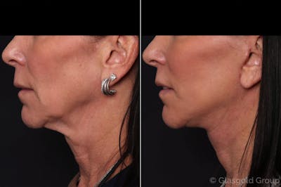 Facelift Before & After Gallery - Patient 816194 - Image 1