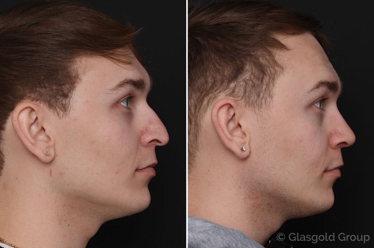 Rhinoplasty Before & After Gallery - Patient 133074 - Image 1