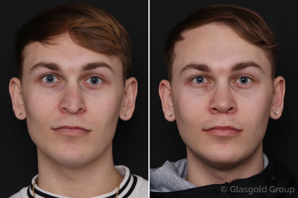 Rhinoplasty Before & After Gallery - Patient 133074 - Image 2