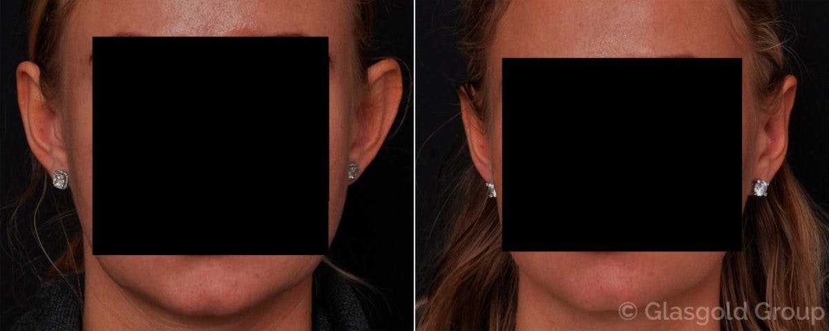 Otoplasty Before & After Gallery - Patient 300318 - Image 1