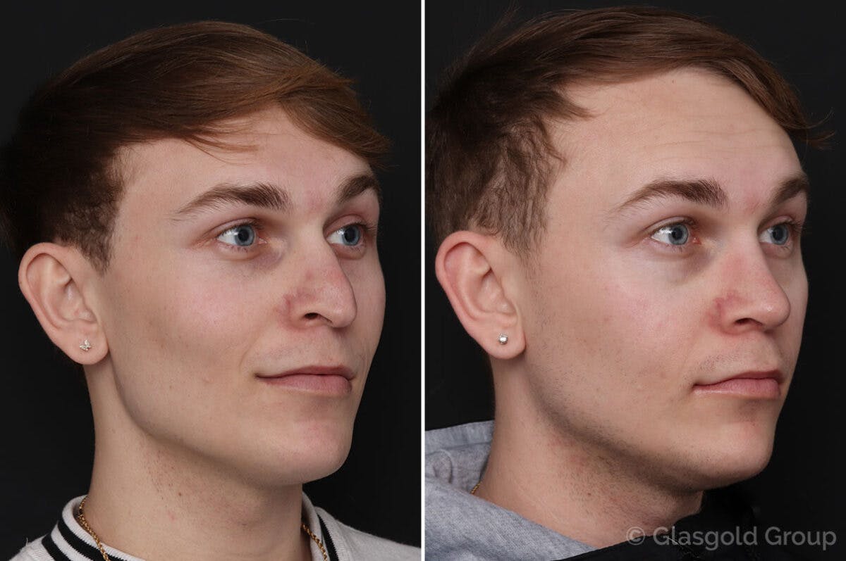 Rhinoplasty Before & After Gallery - Patient 133074 - Image 3