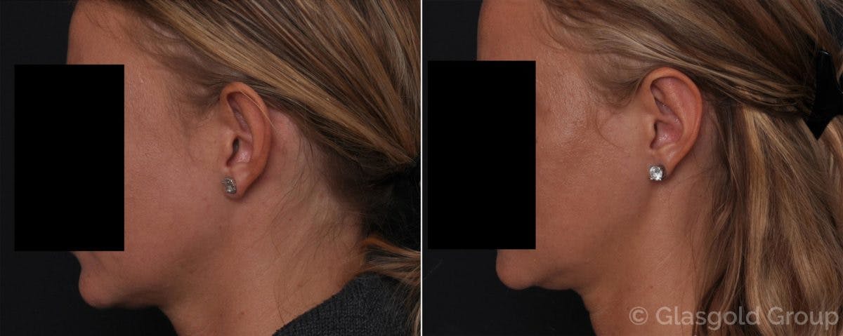 Otoplasty Before & After Gallery - Patient 300318 - Image 2