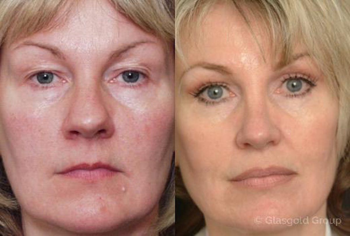 Upper Eyelid Before & After Gallery - Patient 408343 - Image 2