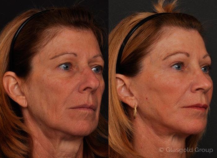 Lower Eyelid Before & After Gallery - Patient 409964 - Image 1
