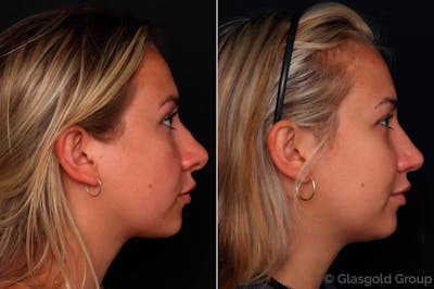 Revision Rhinoplasty Before & After Gallery - Patient 724015 - Image 1