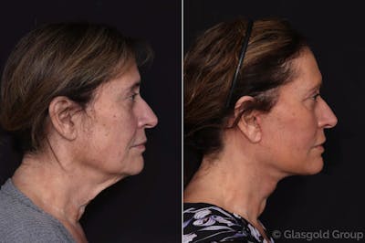Facelift Before & After Gallery - Patient 203587 - Image 1