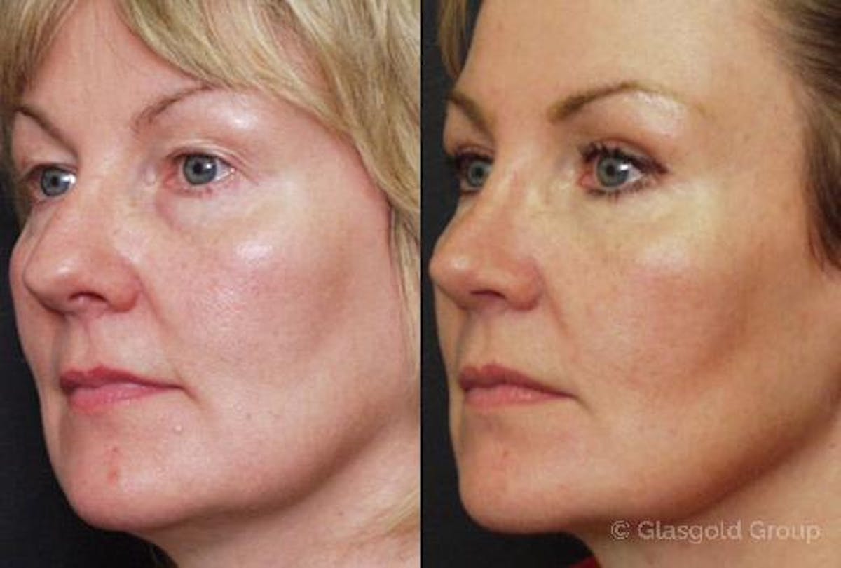 Upper Eyelid Before & After Gallery - Patient 408343 - Image 1