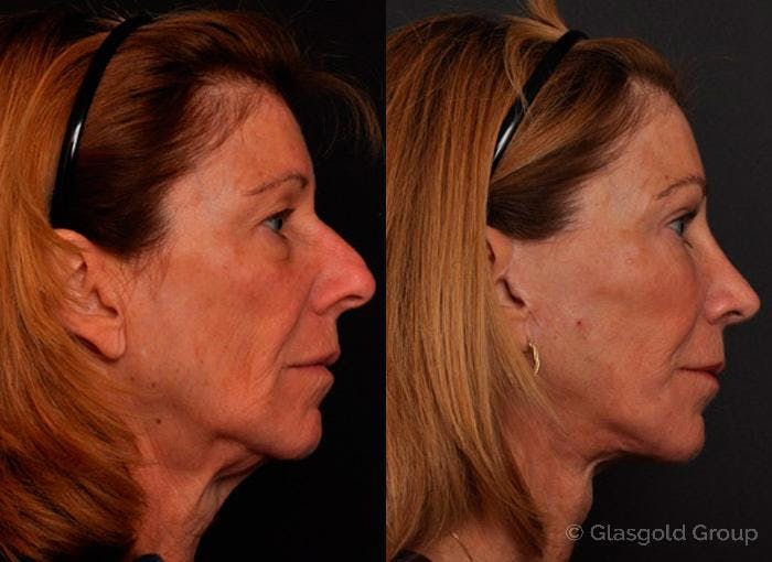 Lower Eyelid Before & After Gallery - Patient 409964 - Image 2