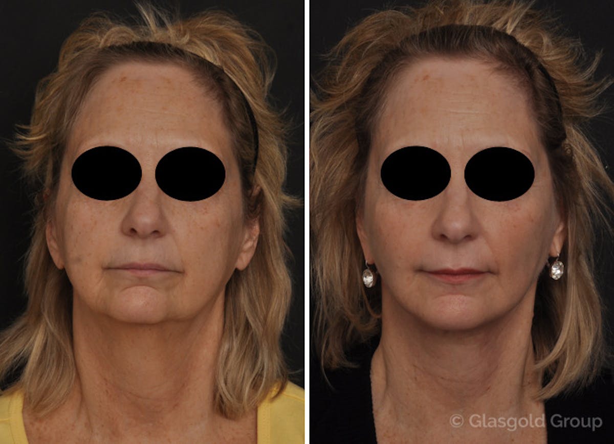 Revision Facelift Before & After Gallery - Patient 782871 - Image 2