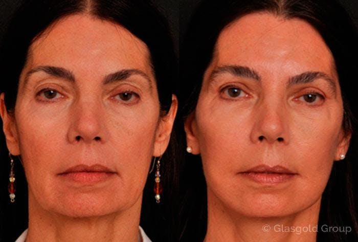 Upper Eyelid Before & After Gallery - Patient 375851 - Image 1