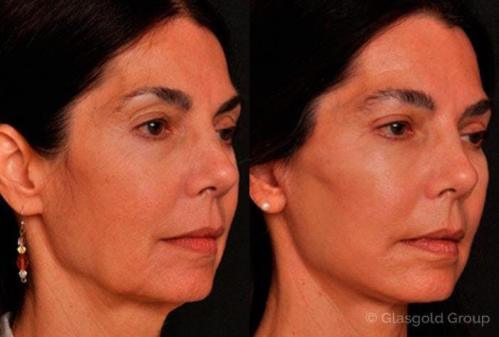 Upper Eyelid Before & After Gallery - Patient 375851 - Image 2