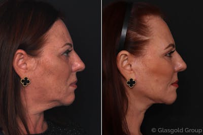 Facelift Before & After Gallery - Patient 896607 - Image 1