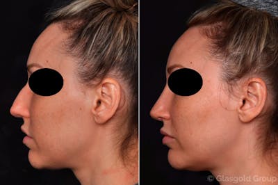 Revision Rhinoplasty Before & After Gallery - Patient 152449 - Image 1