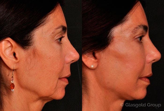 Upper Eyelid Before & After Gallery - Patient 375851 - Image 3