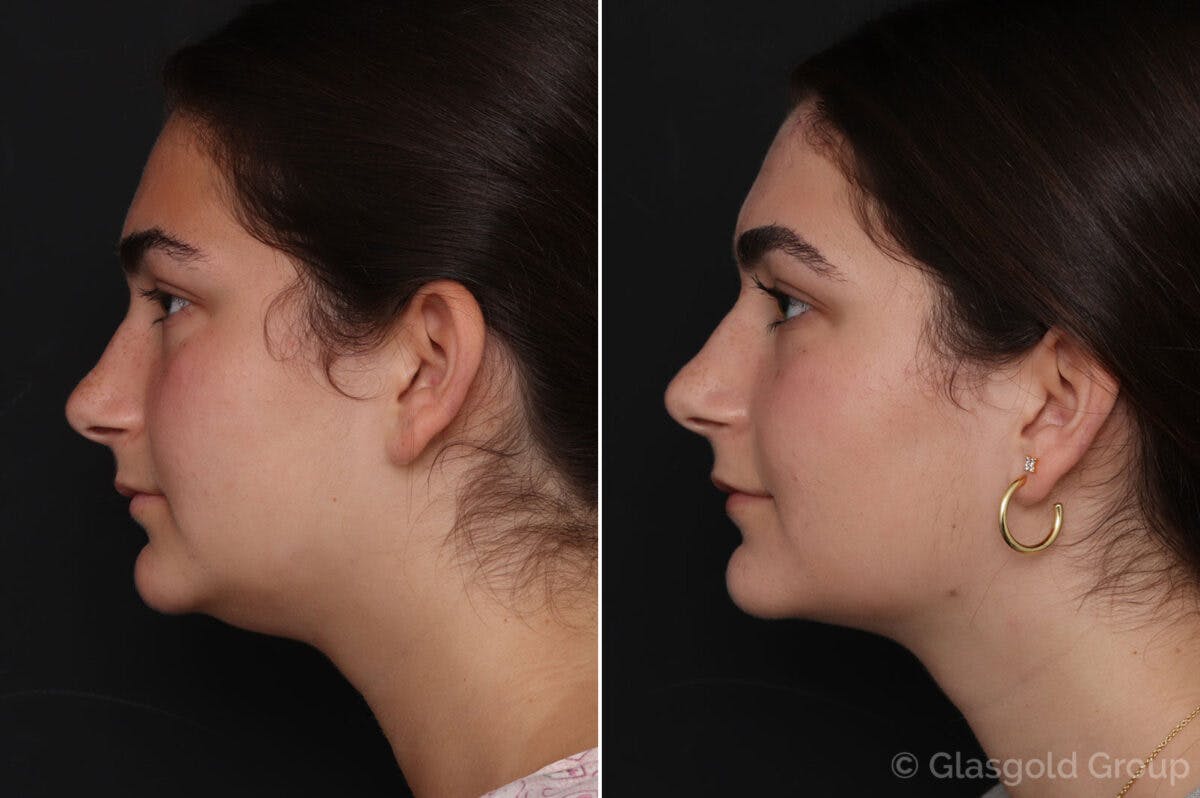 Neck Liposuction Before & After Gallery - Patient 772244 - Image 1