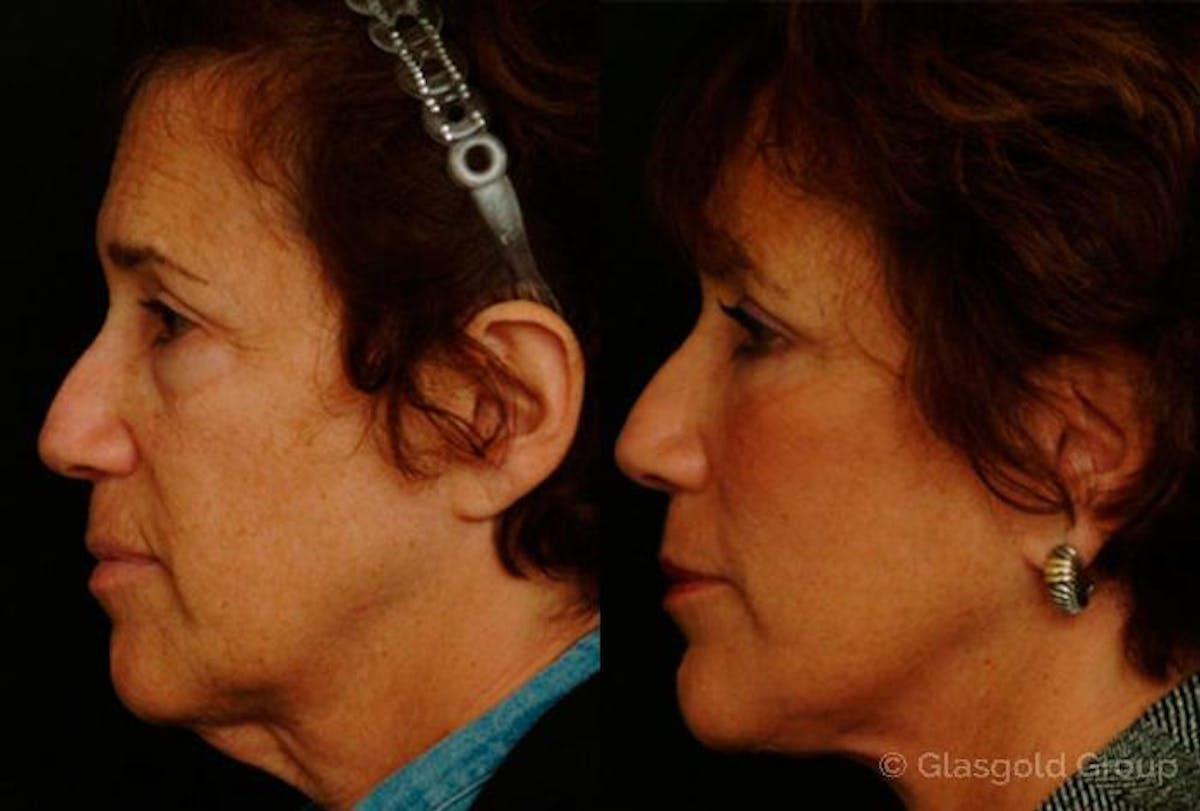 Lower Eyelid Before & After Gallery - Patient 374925 - Image 2