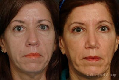 Upper Eyelid Before & After Gallery - Patient 345618 - Image 1