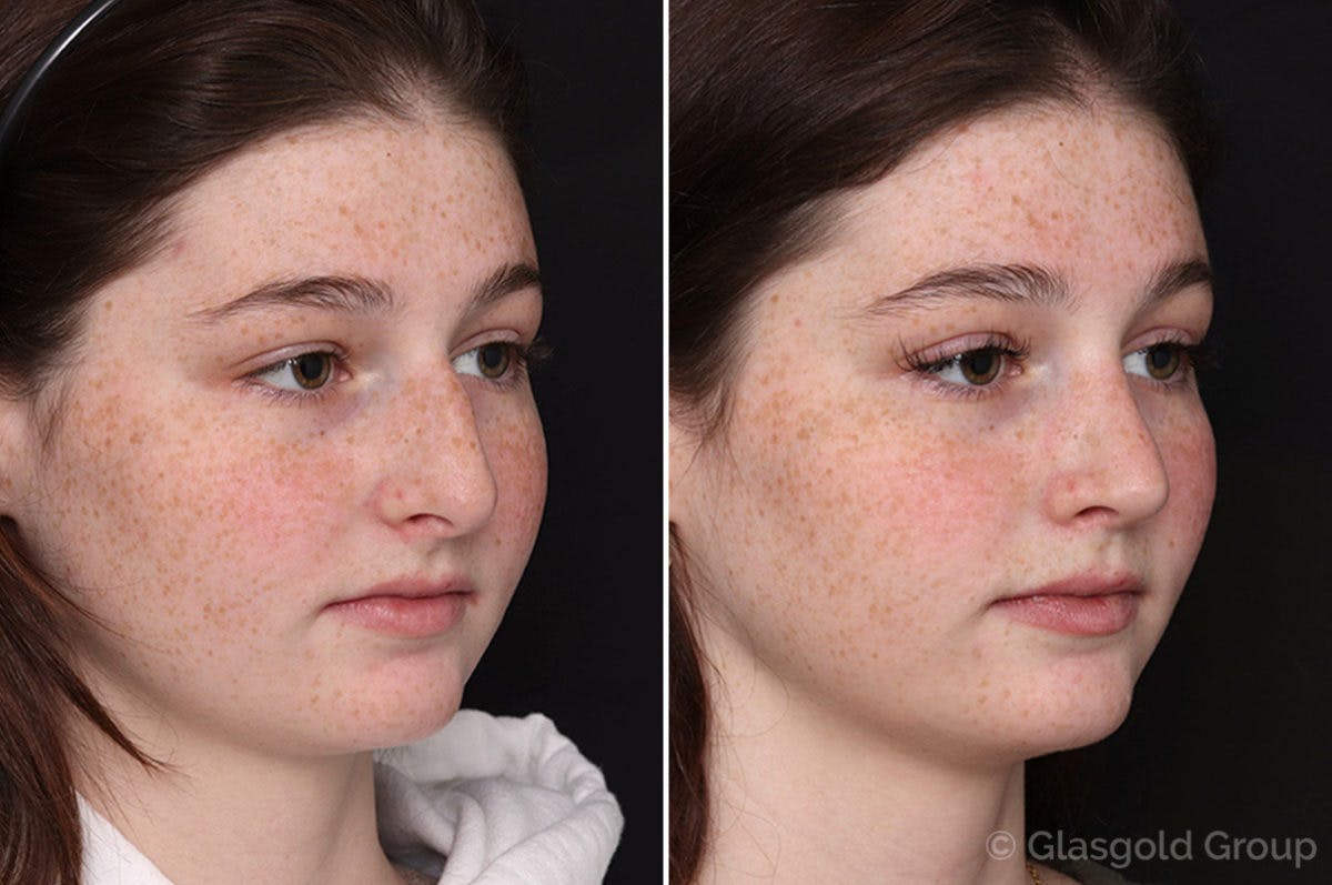Rhinoplasty Before & After Gallery - Patient 371659 - Image 3