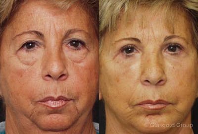 Upper Eyelid Before & After Gallery - Patient 178941 - Image 1