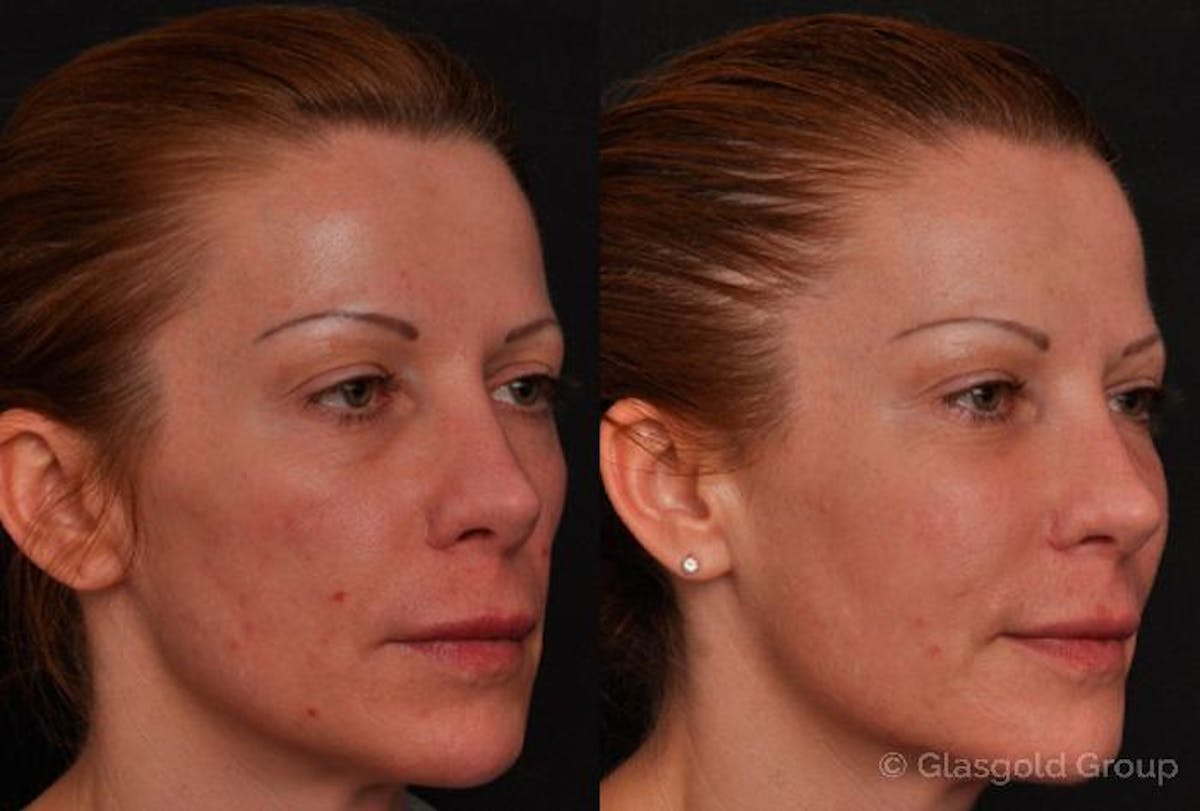 Lower Eyelid Before & After Gallery - Patient 131714 - Image 1