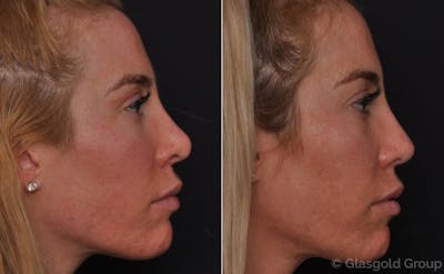 Revision Rhinoplasty Before & After Gallery - Patient 276120 - Image 1