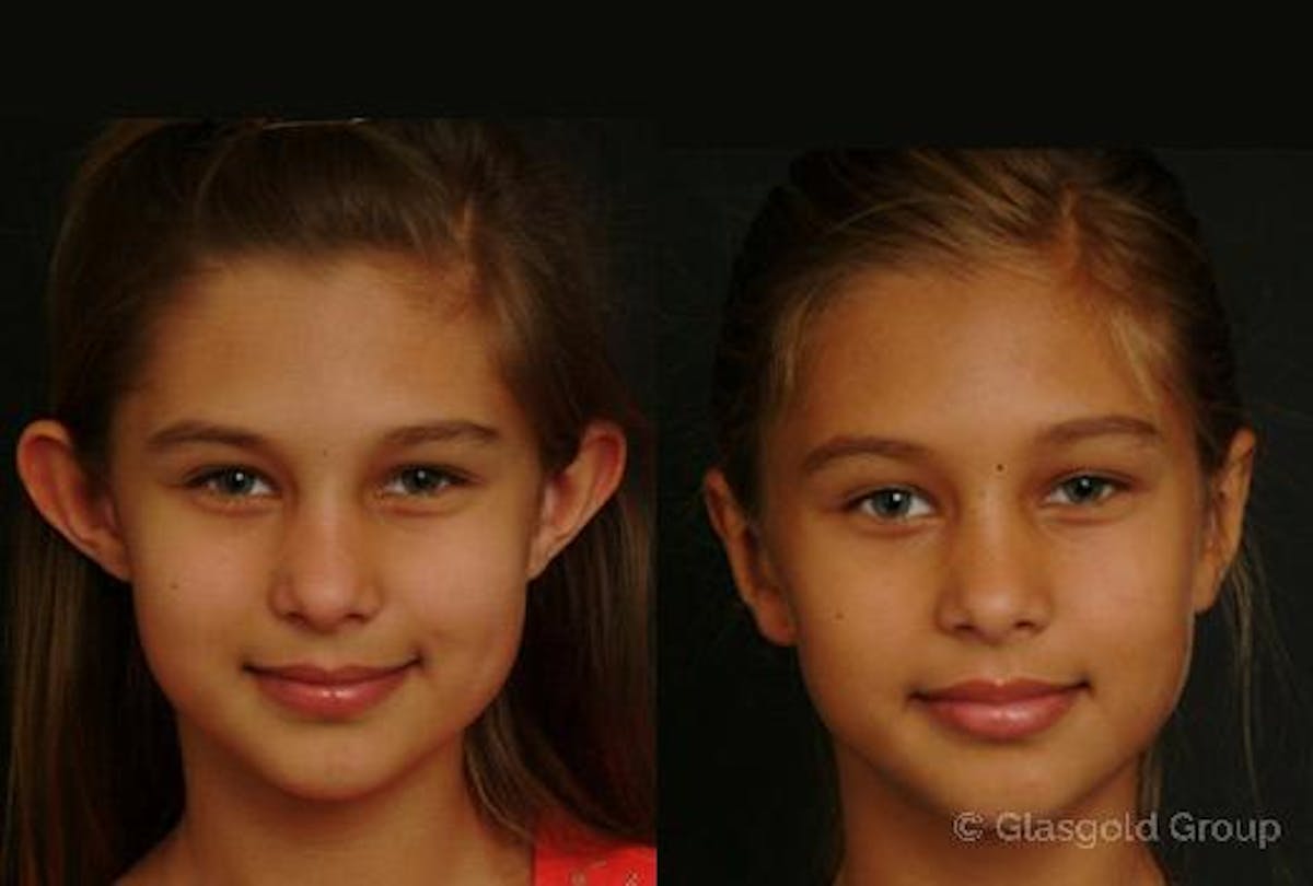 Otoplasty Before & After Gallery - Patient 305291 - Image 1