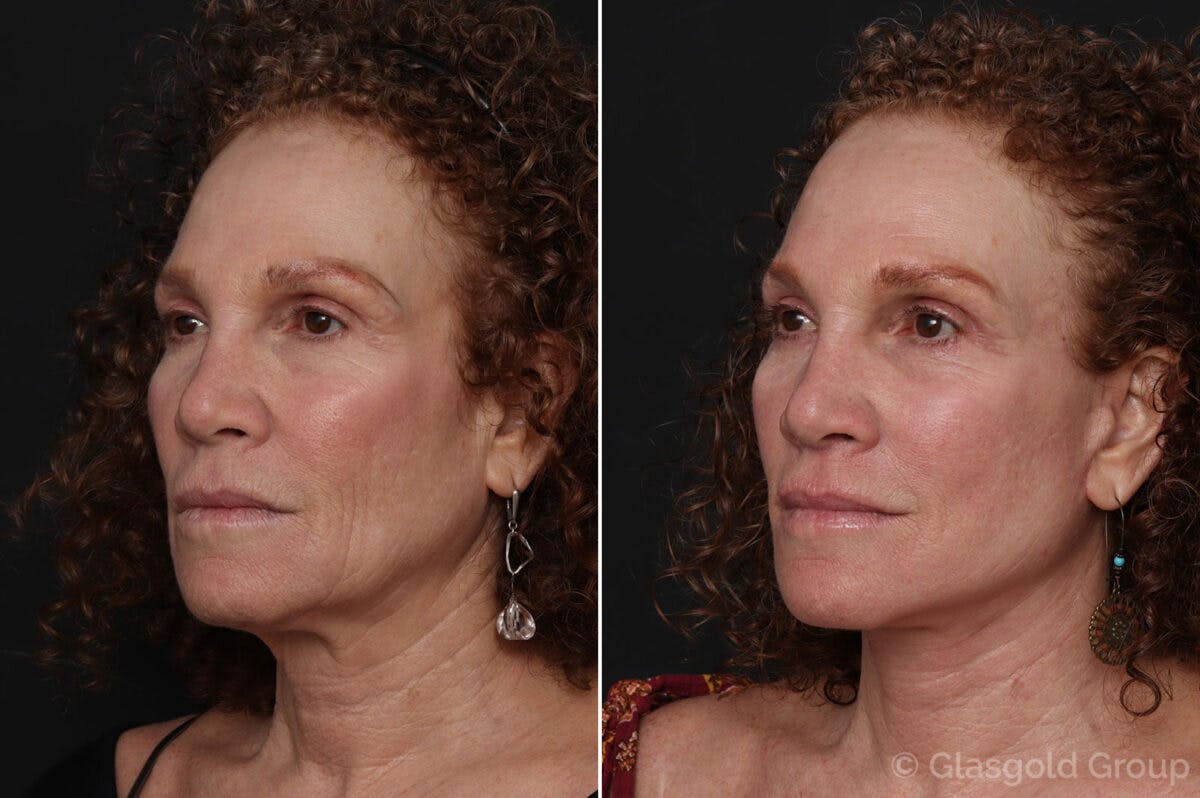 Facelift Before & After Gallery - Patient 221172 - Image 1