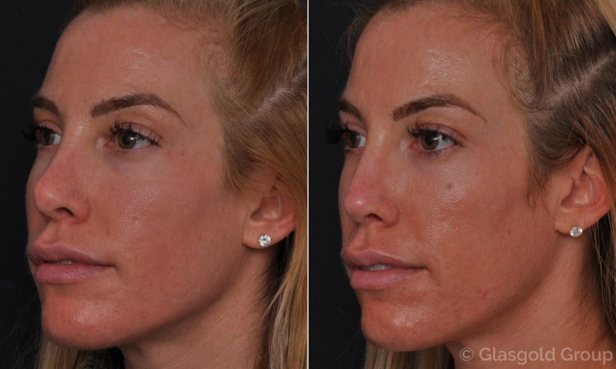 Revision Rhinoplasty Before & After Gallery - Patient 276120 - Image 3