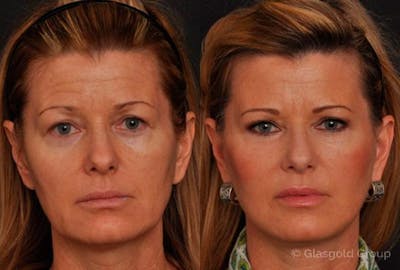 Upper Eyelid Before & After Gallery - Patient 839988 - Image 1