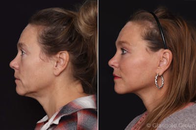 Facelift Before & After Gallery - Patient 389483 - Image 1