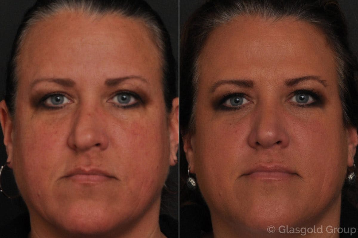 Revision Rhinoplasty Before & After Gallery - Patient 261259 - Image 2