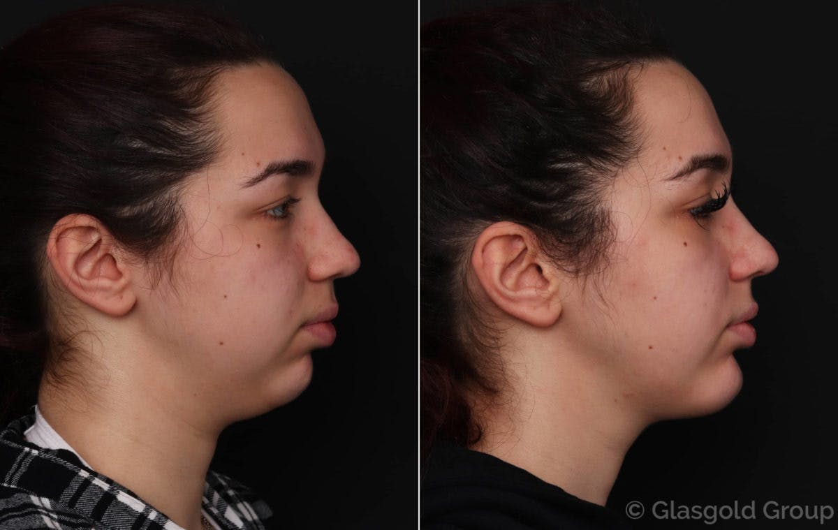 Neck Liposuction Before & After Gallery - Patient 560698 - Image 1