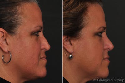 Revision Rhinoplasty Before & After Gallery - Patient 261259 - Image 1