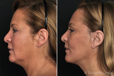Facelift Before & After Gallery - Patient 134370 - Image 1