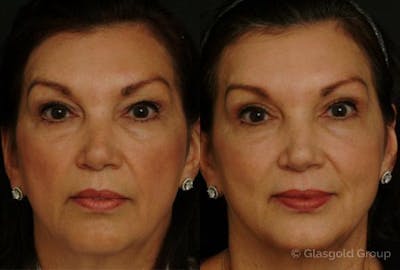 Upper Eyelid Before & After Gallery - Patient 390953 - Image 1