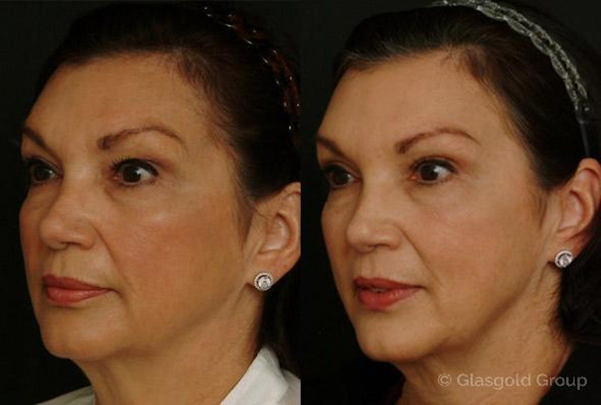 Upper Eyelid Before & After Gallery - Patient 390953 - Image 1
