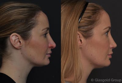 Revision Rhinoplasty Before & After Gallery - Patient 802957 - Image 1