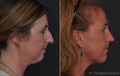 Chin Implants Before & After Gallery - Patient 359630 - Image 1