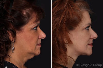 Facelift Before & After Gallery - Patient 265645 - Image 1
