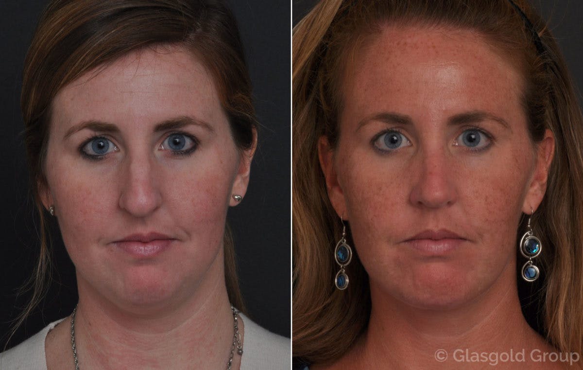Chin Implants Before & After Gallery - Patient 359630 - Image 3