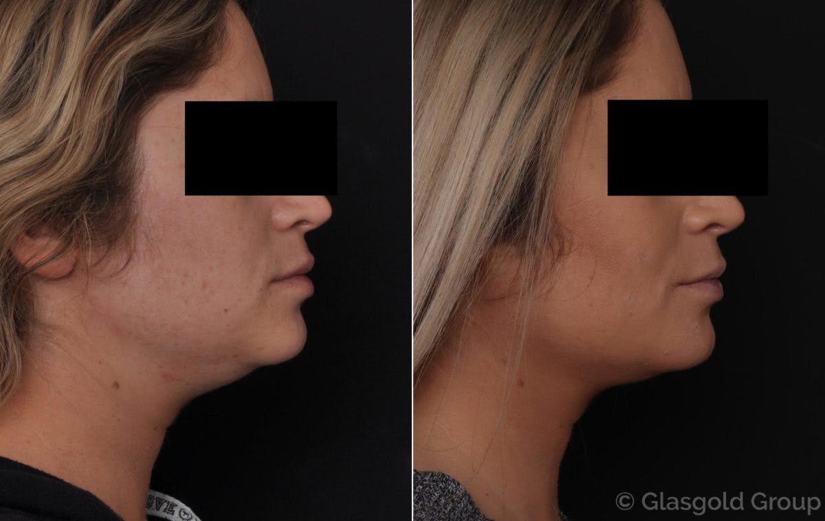 Neck Liposuction Before & After Gallery - Patient 112428 - Image 1